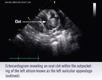 Pet ultrasound scan of Clot