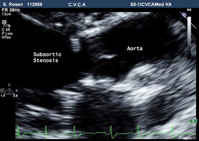 The abnormal tissue obstructing normal flow out of the left ventricle is shown.