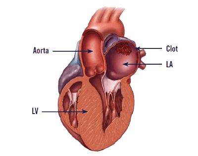 Heart disease graphic