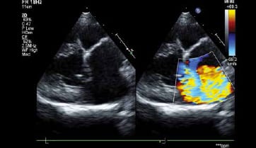 Echocardiogram images taken simultaneously