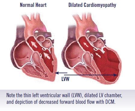 dialated-cardiomyopathy
