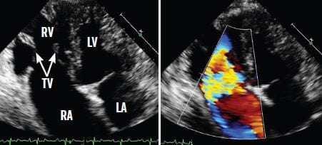 echocardiogram