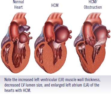 hypertrophic-cardiomyopathy