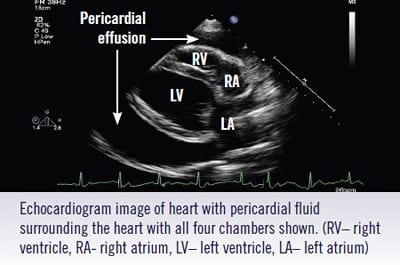 pericardial-diagram