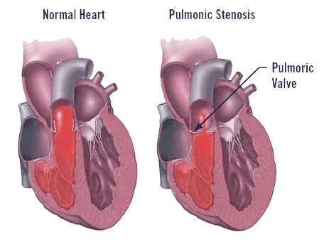 pulmonic-stenosis